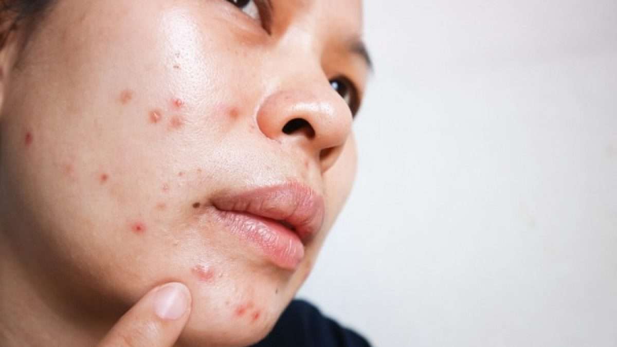 acne.jpg