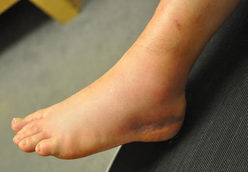 sprained_ankle_home_remedies.jpg