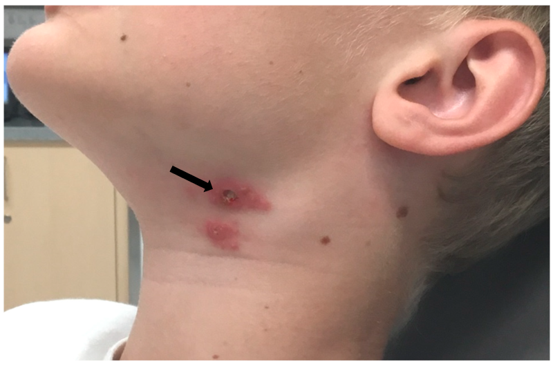 स्किन पर छाले या फोड़े क्यों होते हैं, आप भी जानें इसके कारण, लक्षण, इलाज और घरेलू उपचार के बारे में