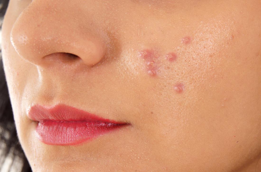 easy treatment of acne and its pain relief
