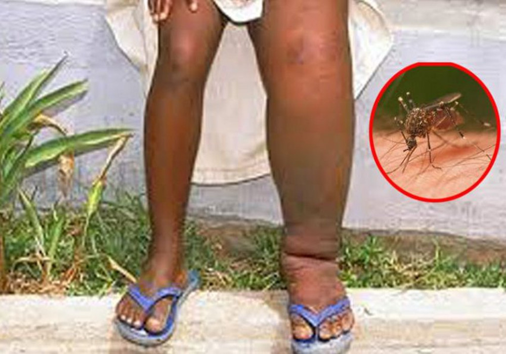 सावधान :मच्छरो के काटने से होता हैं फाइलेरिया