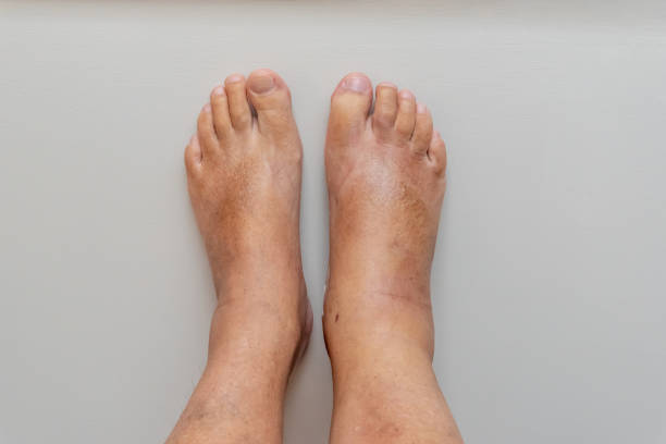 Swollen Legs: अगर आपके भी पैरों में सूजन है तो उससे राहत पाने के लिए अपनाएं ये उपाय