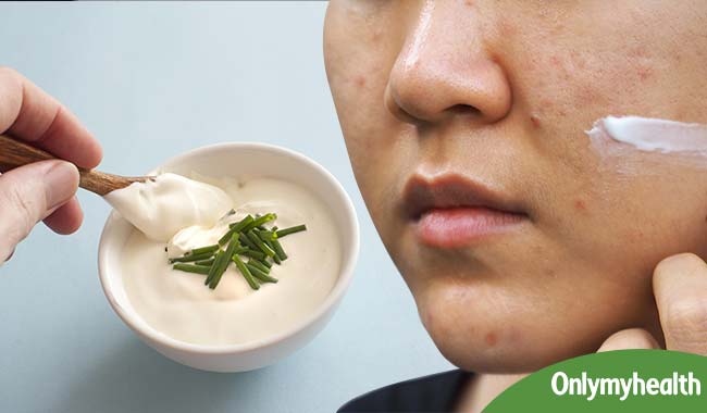 easy home remedies for the problem of acne