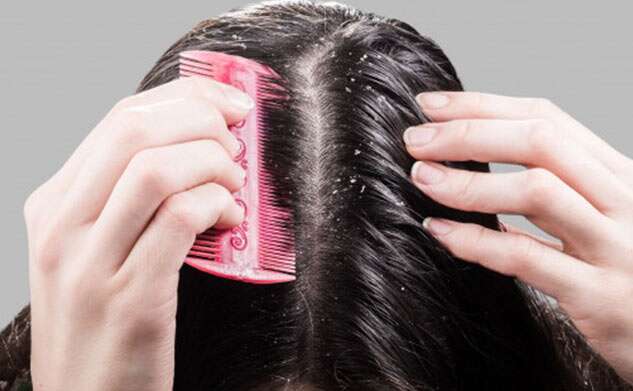 reason of dandruff in winter and easy tips that will remove dandruff