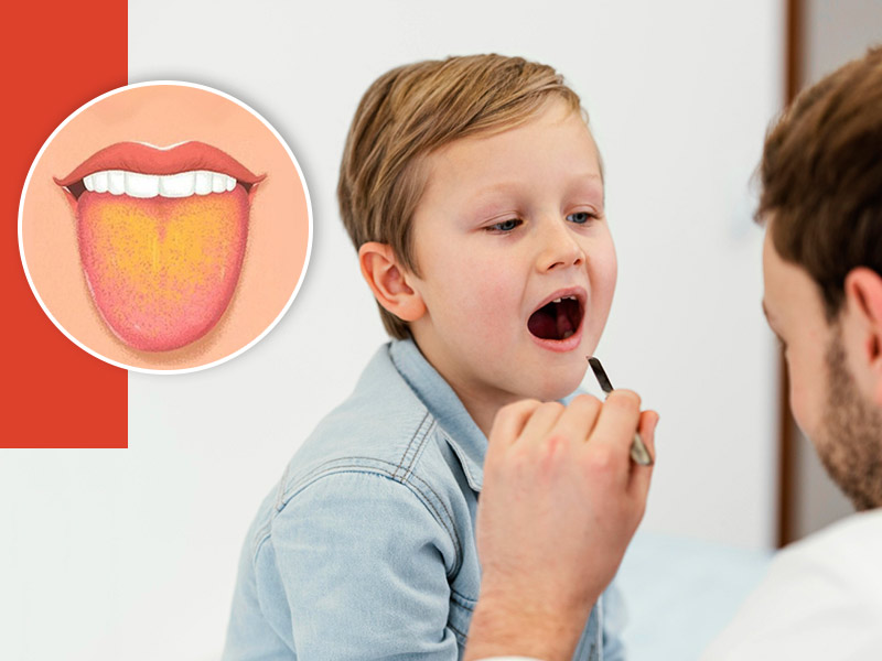 what can be the reason for the yellow coating on the tongue of children