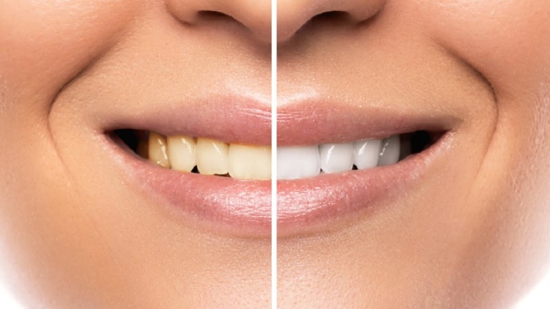 yellow teeth home remedies