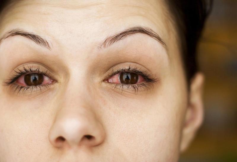 STD symptoms: आंखो में कैसे दिखते हैं यौन सबंधित बीमारी के लक्षण