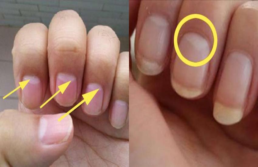 आपके नाखून पर है कोई छोटा सा निशान? इस चिन्ह को ना करें नज़रअंदाज, हो सकता  है धन लाभ - white mark on nails is auspicious or inauspicious according to  vastu shastra