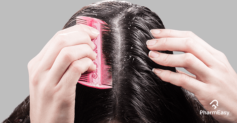 easy tips for remove the dandruff