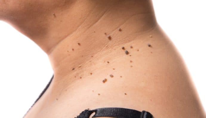 Home Remedies for Warts: मस्सों के लिए प्रभावकारी घरेलू नुस्खे