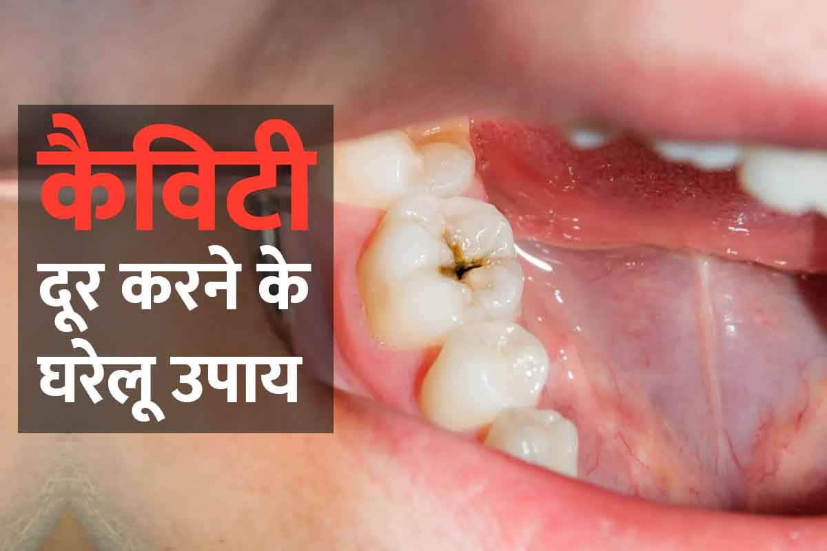 Home Tips to Remove Cavity From Teeth