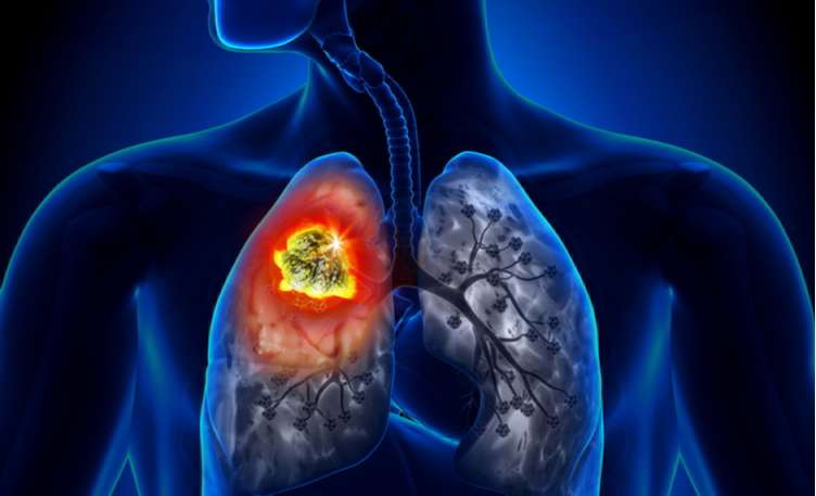 Home Remedies Beneficial for Lung Cancer In Hindi