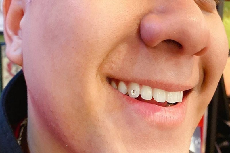 Tooth gems good or bad