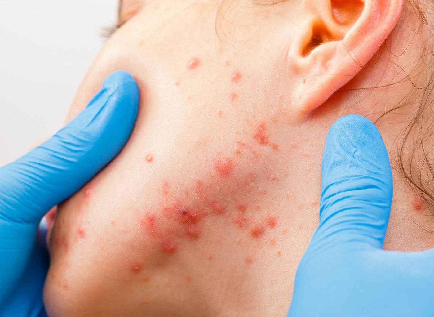 New possible therapies from acne risk gene discover