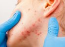 New possible therapies from acne risk gene discover