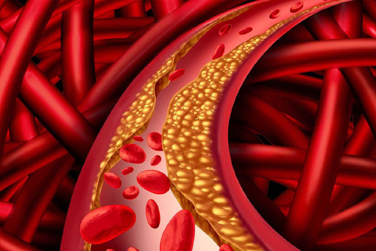 Risk of Hypercholesterolemia in Corona Infected People