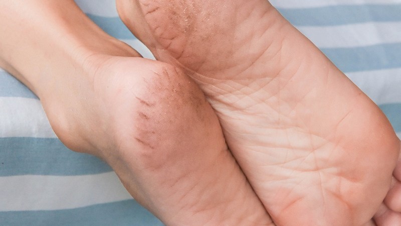 cracked heels reason, cracked heels causes, vitamin deficiency, vitamin deficiency symptoms, vitamin b3 deficiency, vitamin e deficiency, vitamin c deficiency