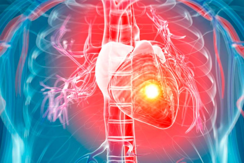 Silent Heart Attack Signs and Symptoms