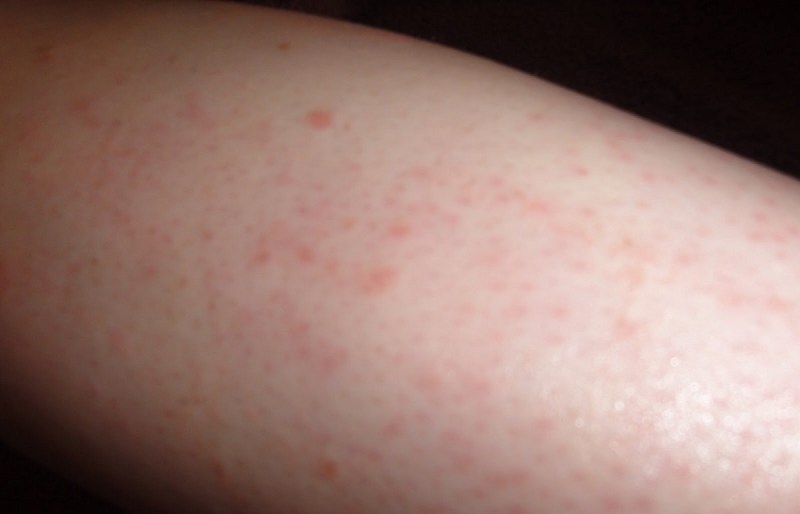 after waxing rashes, red rashes after waxing, waxing rashes home remedies, rash after waxing, वैक्सिंग रैशेज से छुटकारा पाएँ, natural home remedies,