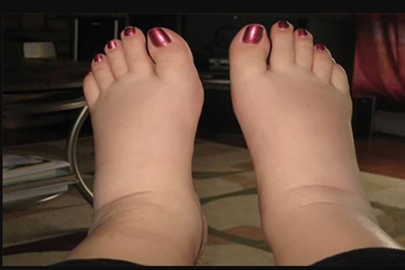 Causes of swelling in the body