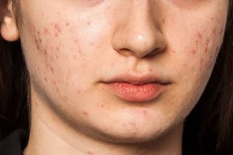 Remedies to remove stains on face