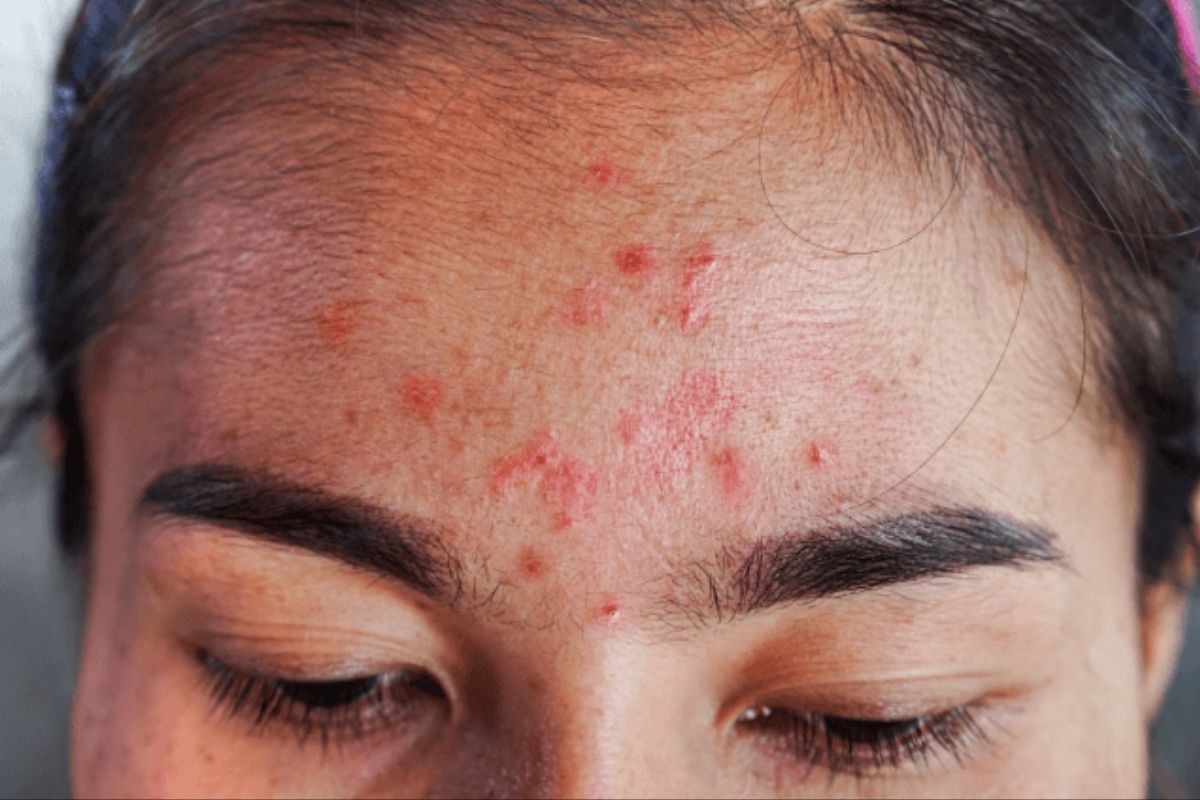 Little bumps on forehead