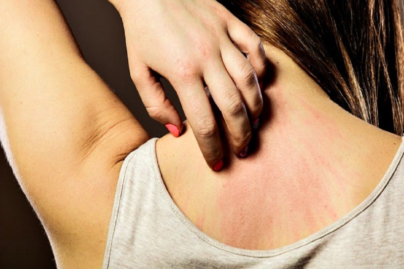 skin allergy home remedies, skin rashes home remedies, natural home remedies, home remedies for itchy skin in hindi, स्किन एलर्जी से आराम, skin care tips,