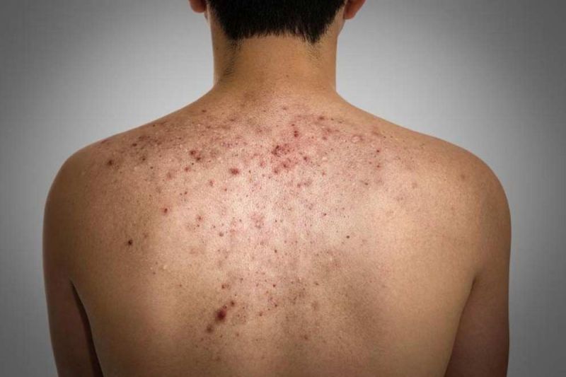 pimples_on_the_back.jpg