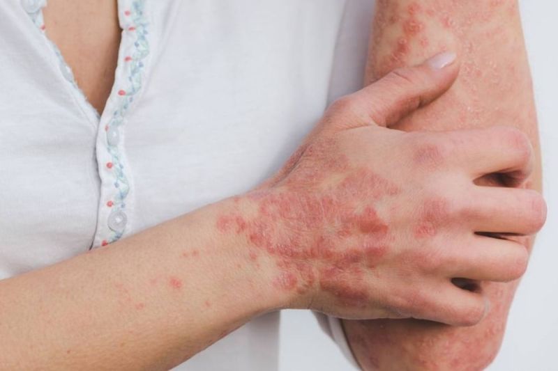psoriasis.jpg
