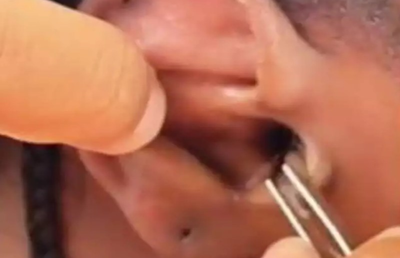 Crab Enters girl Ear