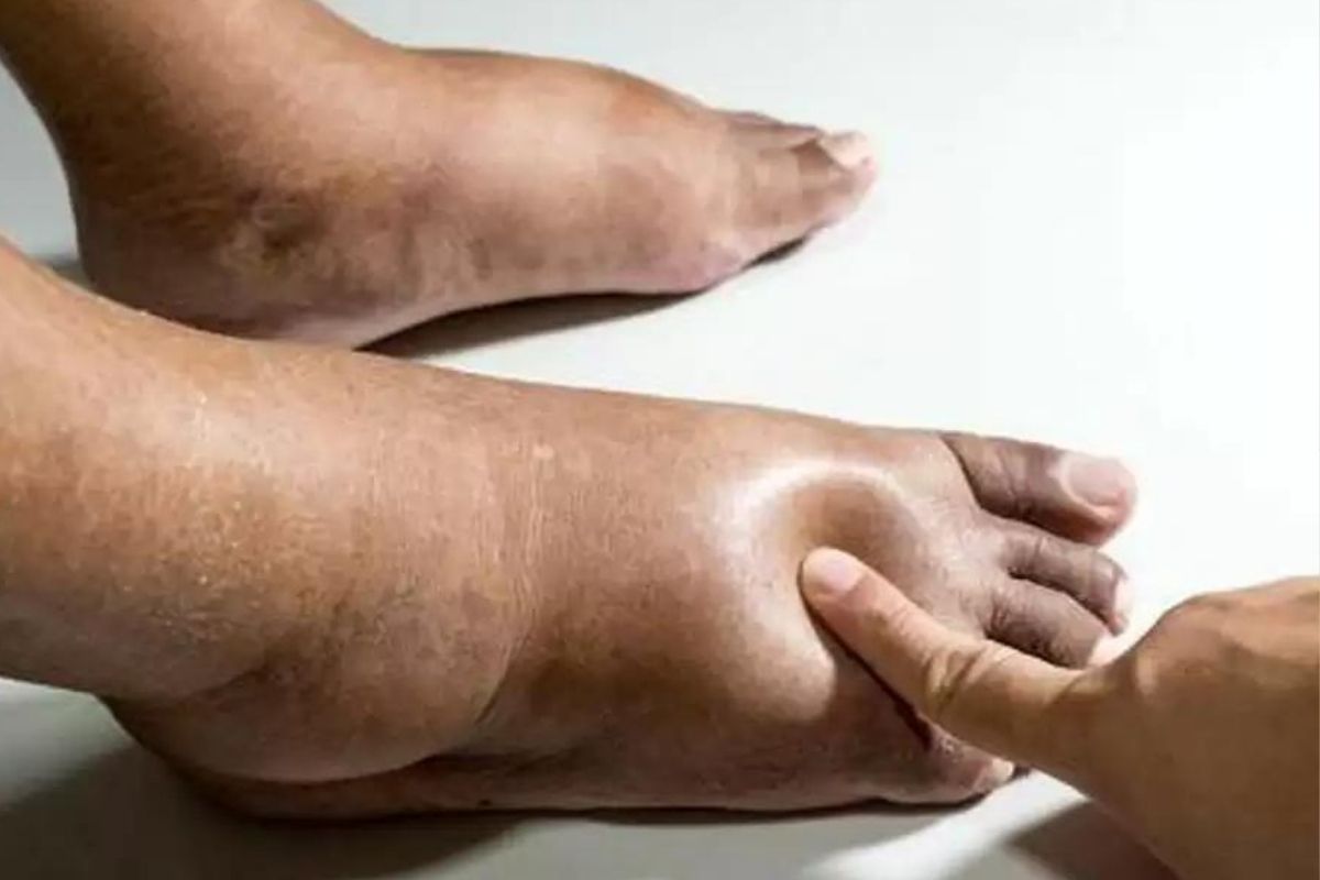 पैरों की सूजन और दर्द को करना है कम, तो इन टिप्स और होम रेमेडी से मिलेगा क्विक
आराम - image