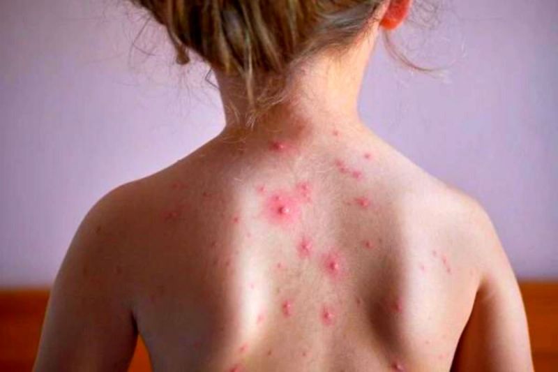 measles-chickenpox_identification_causes_and_symptoms_skin_red_rash.jpg