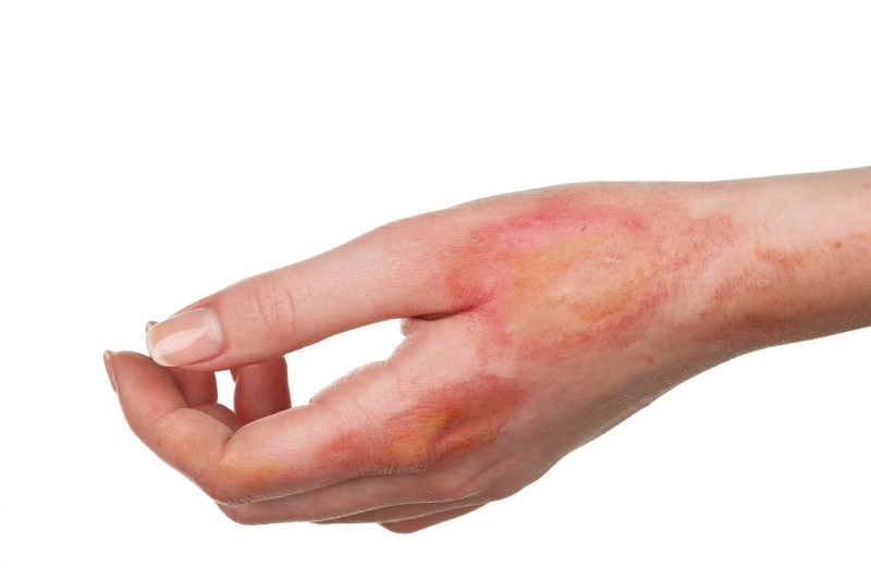 Home Remedies for Burning Hands: किचन में काम करते समय अगर आपके हाथ जल जाए, तो तुरंत राहत पाने के लिए अपनाएं ये घरेलू उपाय