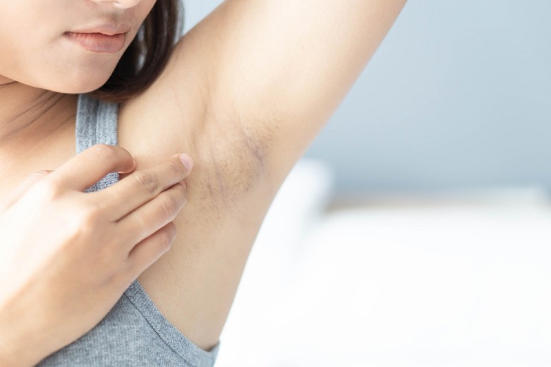 Home Remedies for Underarms: अंडरआर्म्स के कालेपन को दूर करना चाहते हैं, तो ये 5 घरेलू नुस्खे आएंगे काम