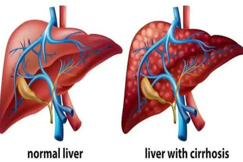 symptoms_of_liver_cirrhosis.jpg