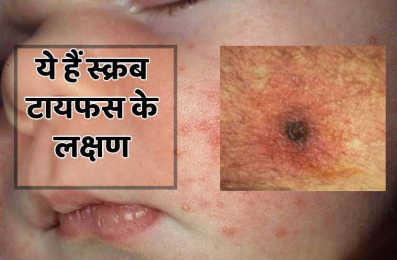 स्क्रब टायफस अलर्ट- 7 से अधिक जिलों में मिले स्क्रब टायफस के मरीज, सावधान रहें