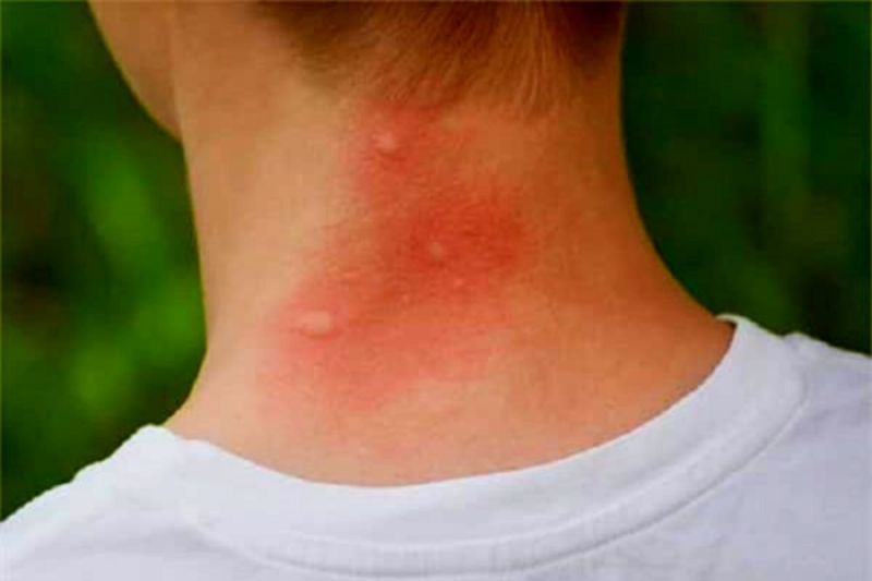 mosquito_bites_allergies_-_home_remedy_for_itching.jpg