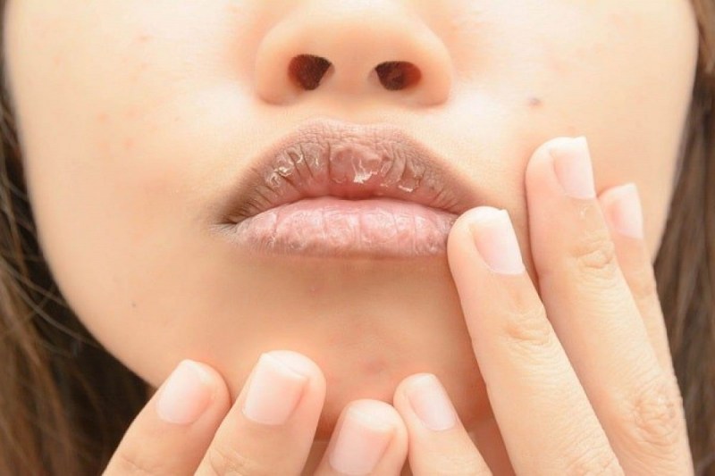 Chapped Lips Home Remedies: फटे होठों की समस्या से राहत दिलाने में काम आएंगे, ये 5 घरेलू नुस्खे
