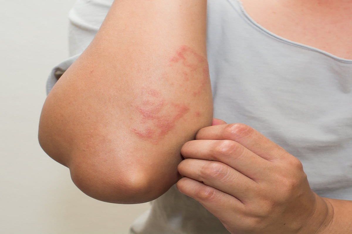 Skin Allergy Home Remedies: अगर आप स्किन की एलर्जी से परेशान हैं, तो ये घरेलू नुस्खे दिलाएंगे निजात