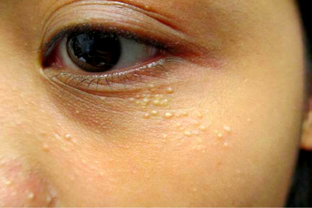 small_white_pimples_under_eyes_causes_and_home_remedies.png