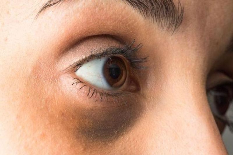 diabetes_sign_symptoms_dark_swelling_puffy_eyes.jpg