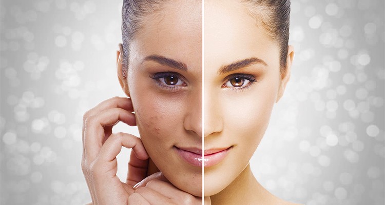Pigmentation Remedies: चेहरे की झाइयों को कहें अलविदा, घरेलू नुस्खे तुरंत दिलाएंगे छुटकारा