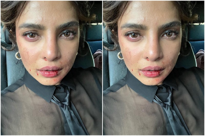 priyanka chopra shared picture with injured face