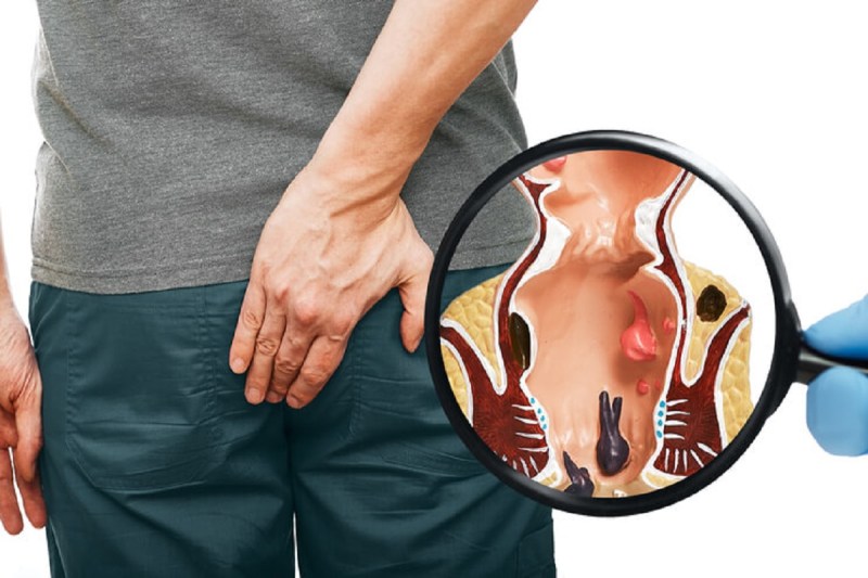 पाइल्स की समस्या से रहते हैं परेशान तो इन फ़ूड का करें सेवन, जल्द मिल सकता है आराम