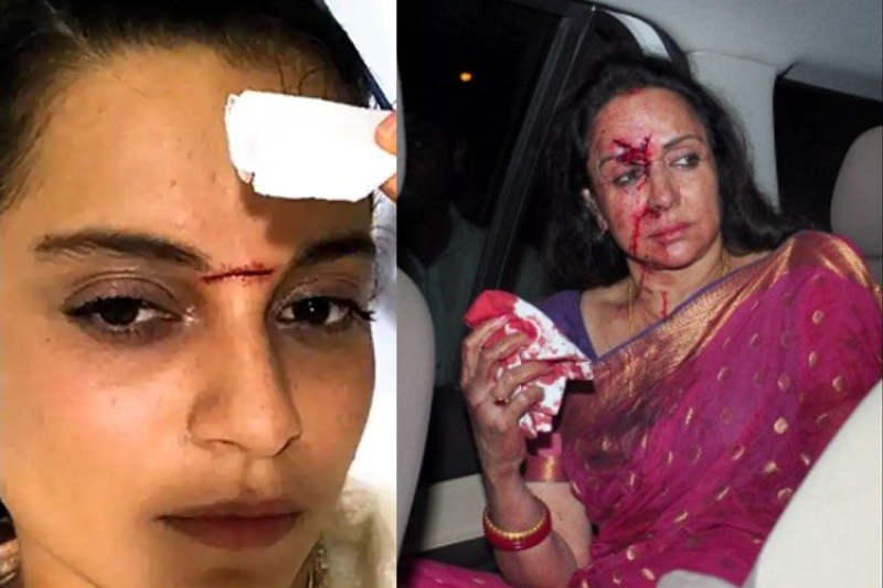 चोट के निशान ने बिगाड़ा इन एक्ट्रेसेस का चेहरा, Kangana से लेकर Hema तक की खूबसूरती पर लगा 'दाग'