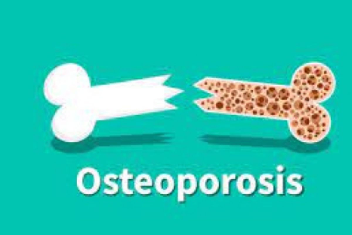 calcium-vitamin_d_severe_deficiency_osteoporosis.jpg