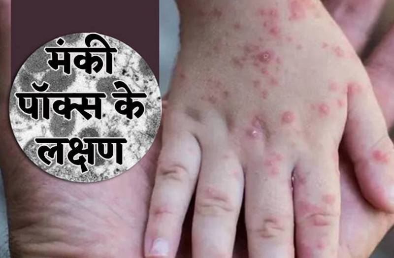 मंकी पॉक्स के ये हैं लक्षण, स्वास्थ विभाग ने किया अलर्ट