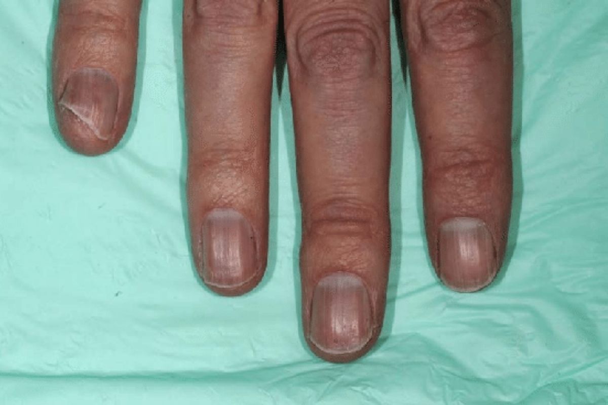 Vitamin B12 Deficiency Weird Skin Findings (& Hair and Nails) - YouTube