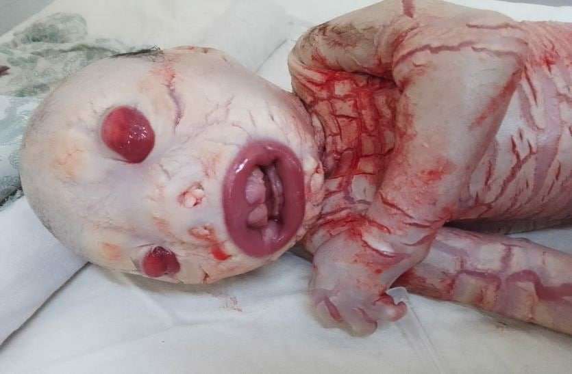 25 साल की महिला ने जन्मा एलियन जैसा बच्चा, मेडिकल में कहते हैं कोलोडियन बेबी