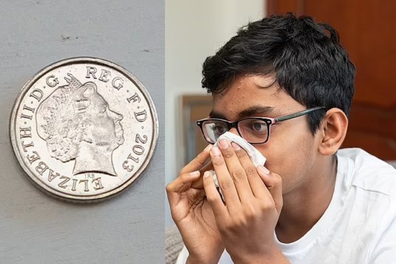 4 साल की उम्र में नाक में फंसा लिया था सिक्का, 10 साल बाद निकली बाहर